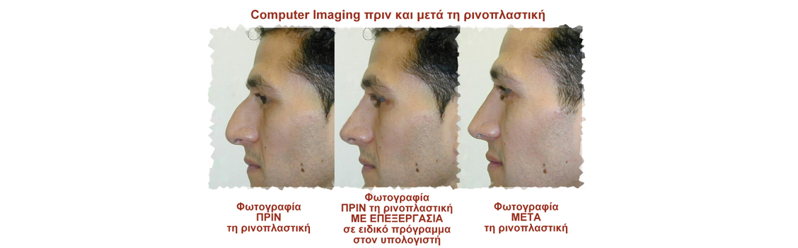 computer imaging για ρινοπλαστικη